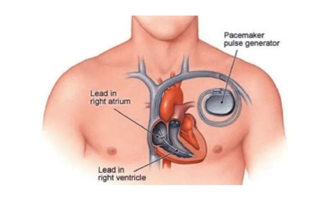 Βηματοδότες